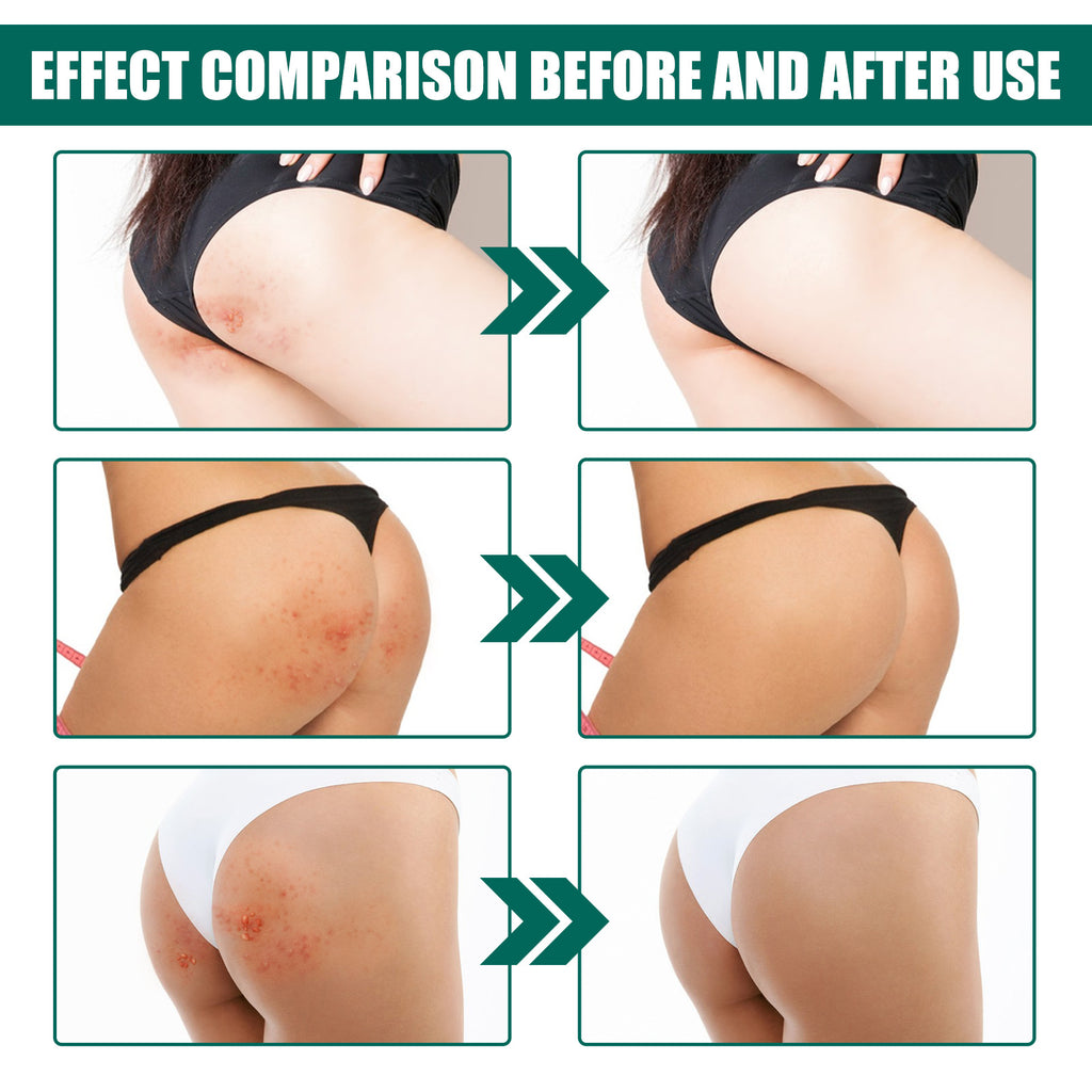 Hip Neck Cream Moisturizing Smallpox Diluting