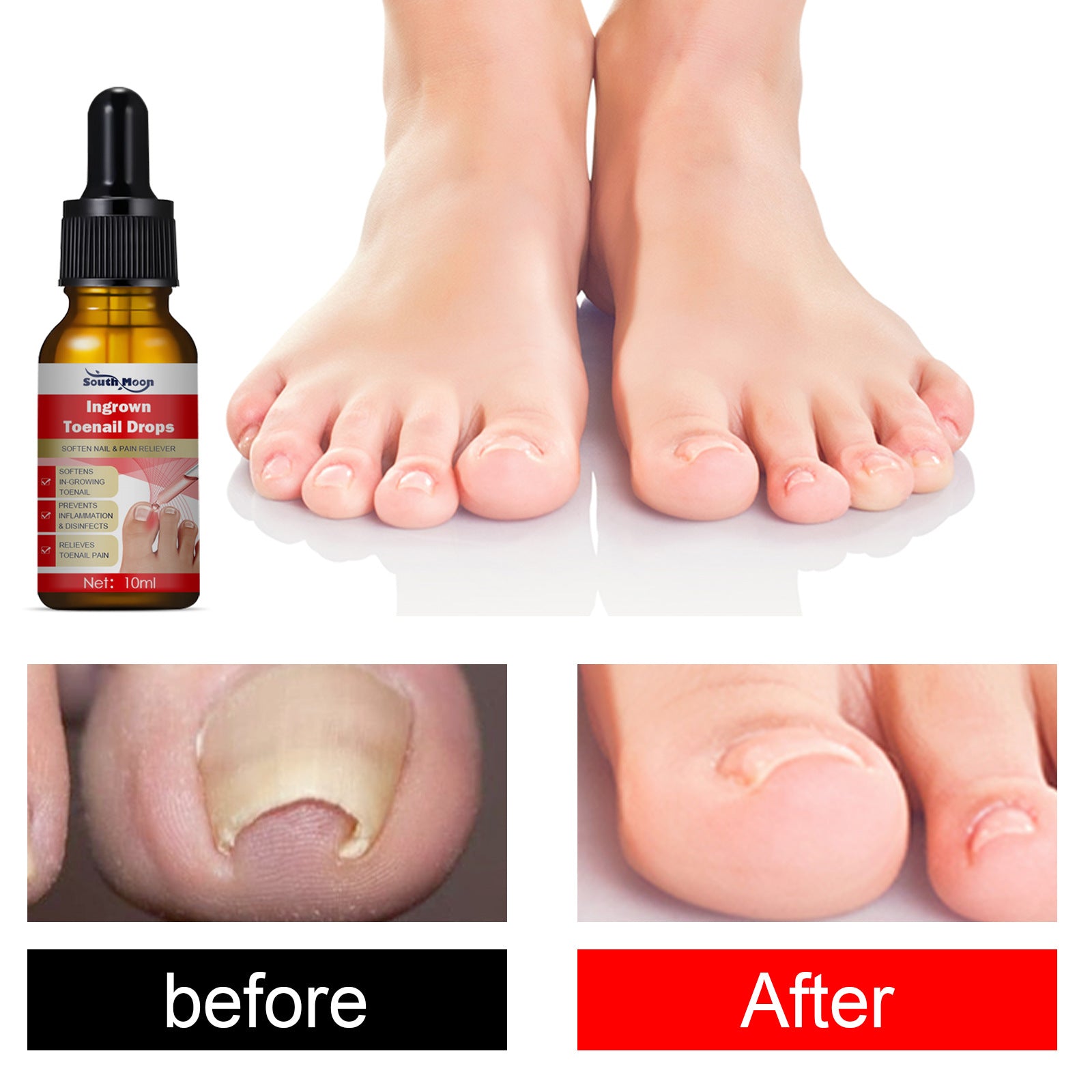 South Moon Endogenous Nail Repair Nail Repair Cleaning Nail Removal Nail Care Essential Oil