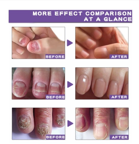 Onychomycosis Liquid Nail Removal Cream Soft Liquid
