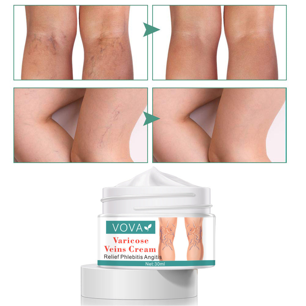 Spider Leg Varicose Vein Repair Cream