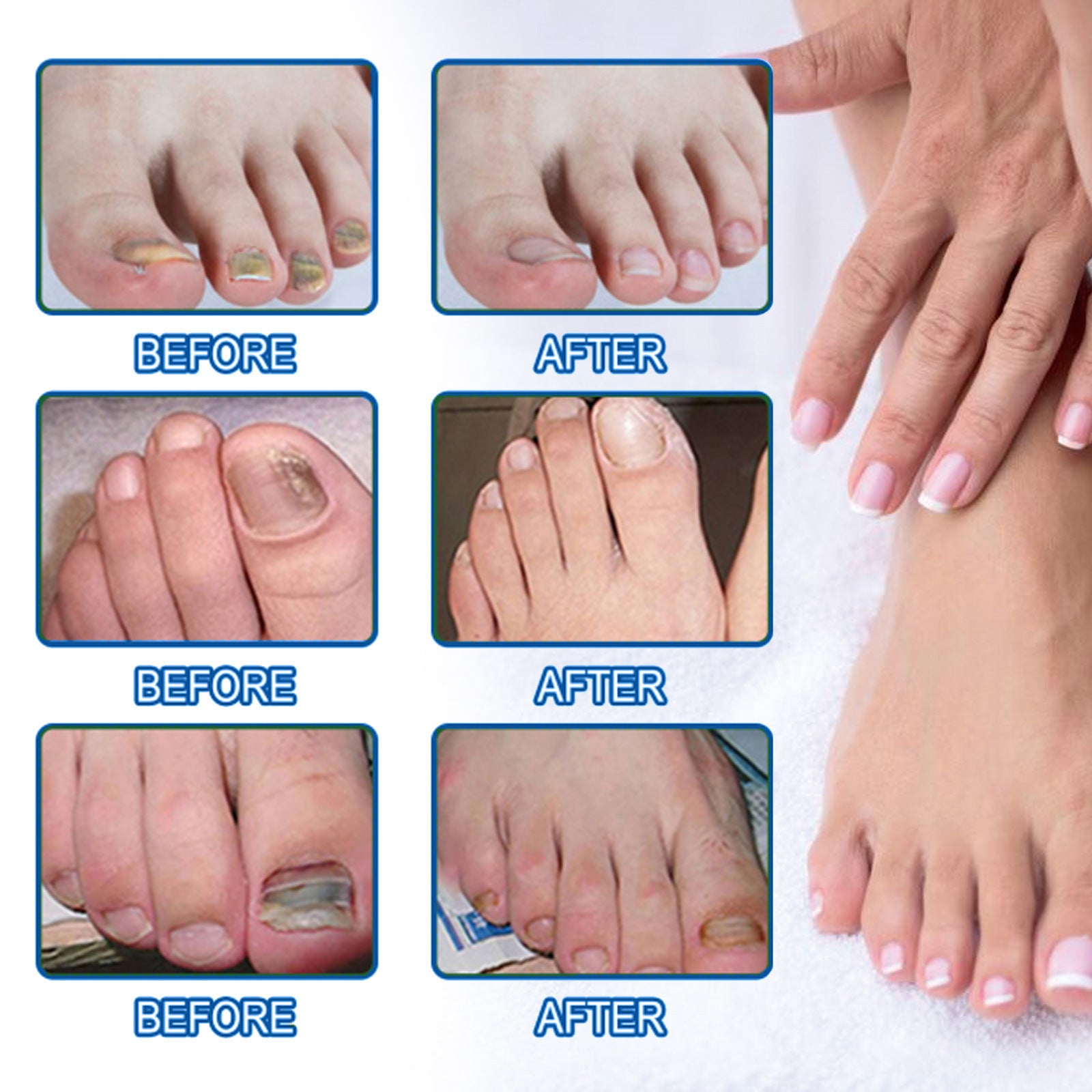Ximonth Nail Nursing Adhesive Bandage Repair