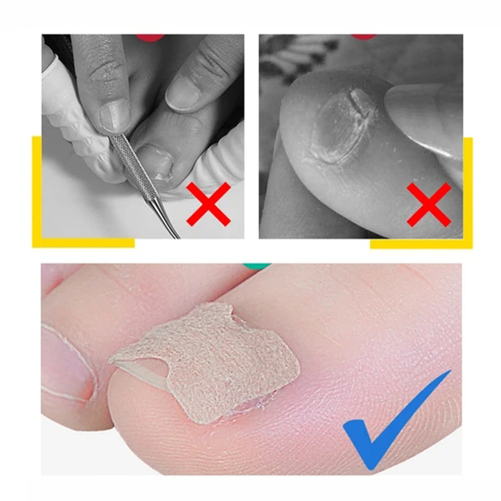 Orthodontic Nail Patch For Orthodontic Nail Correction