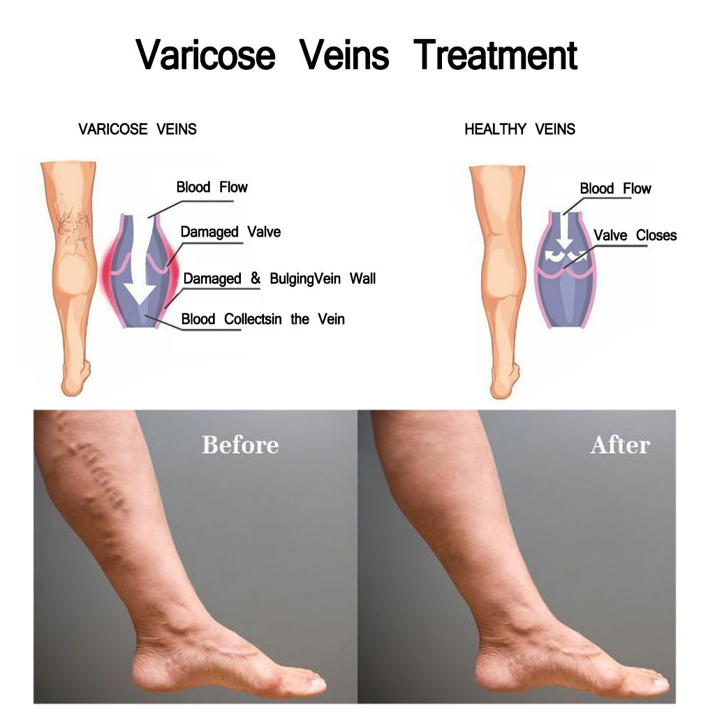 Nursing vein cream