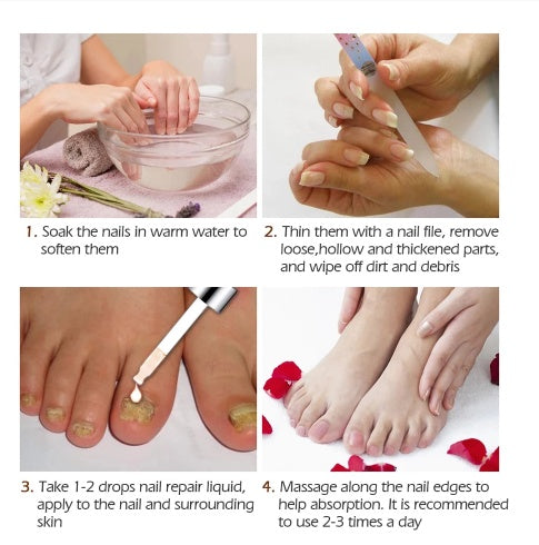 Onychomycosis Liquid Nail Removal Cream Soft Liquid
