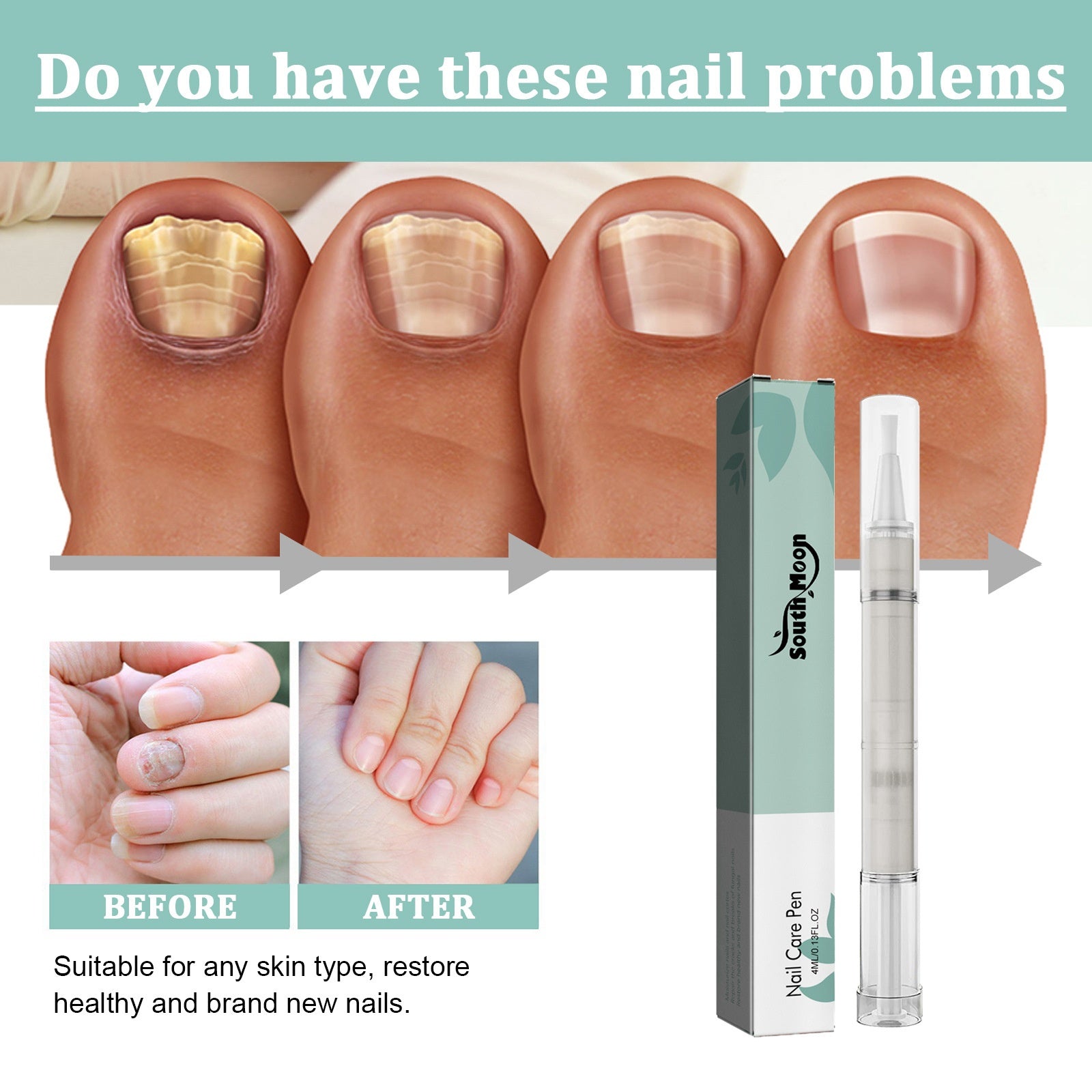 South Moon Nail Repair Pen Nail Removal Dead Skin Barbed Gray Nail Care Nutrition Moisturizing Repair Pen