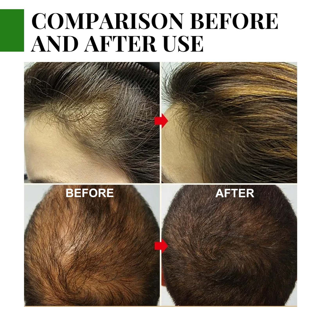 Eelhoe Rosemary Hair Care Capsules Nourish Hair Roots And Prevent Hair Loss