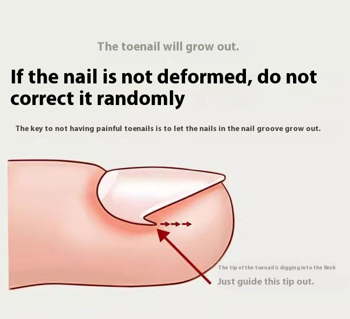 Special Nail Embedding Device For Correcting Paronychia