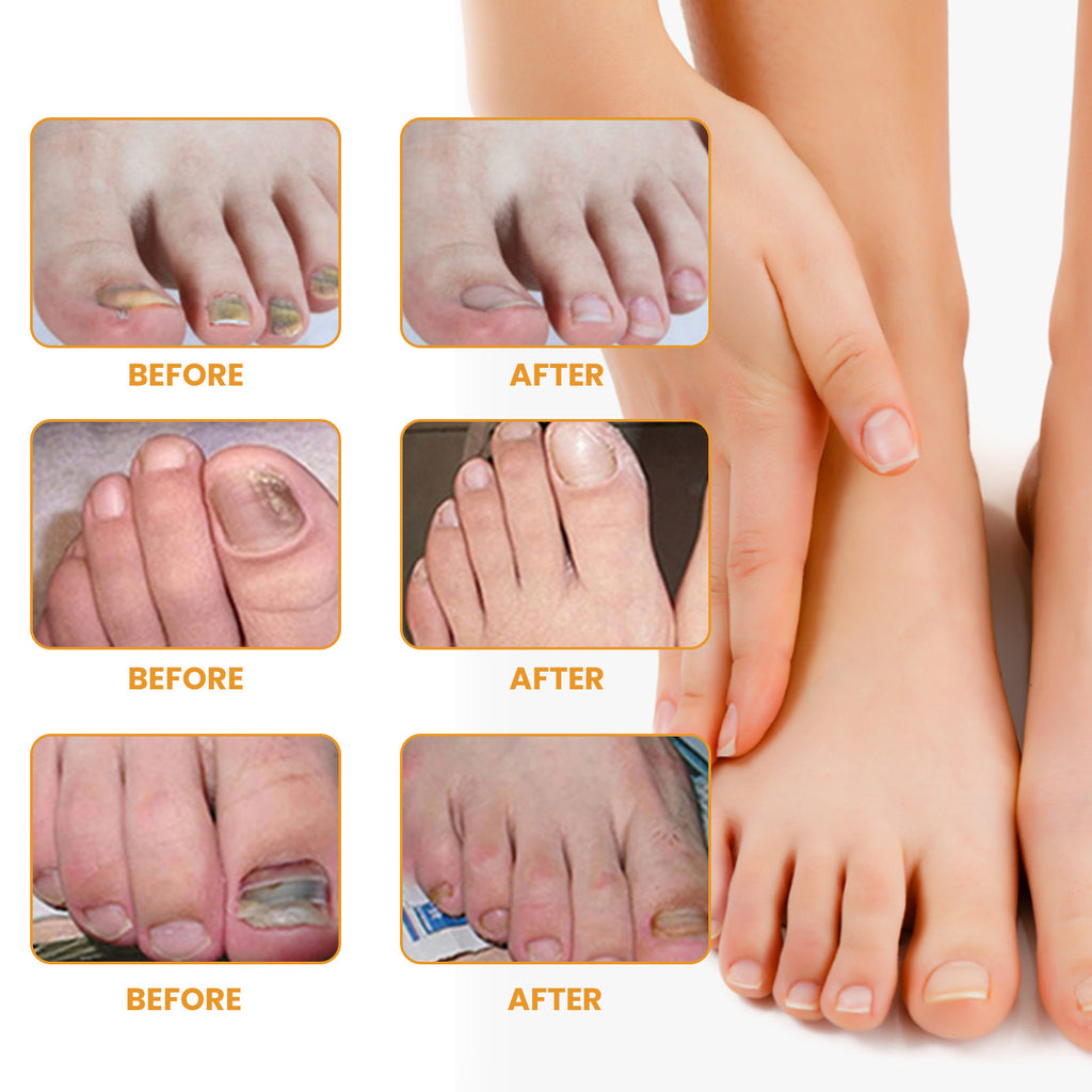 Ximonth Nail Repair Patch Repair Ingrown Nail
