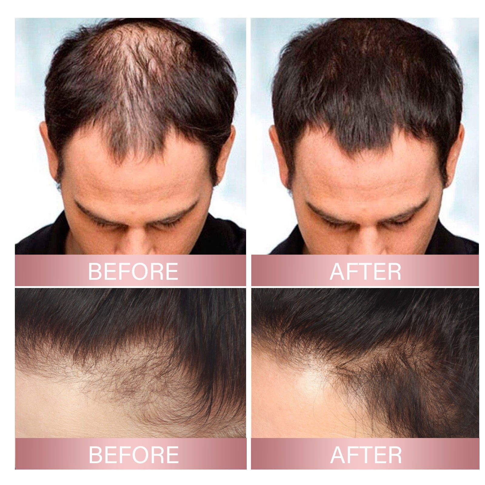 Eelhoe Strong Repair Rice Dense Hair Spray Hair Follicle Hair Root Anti-drop