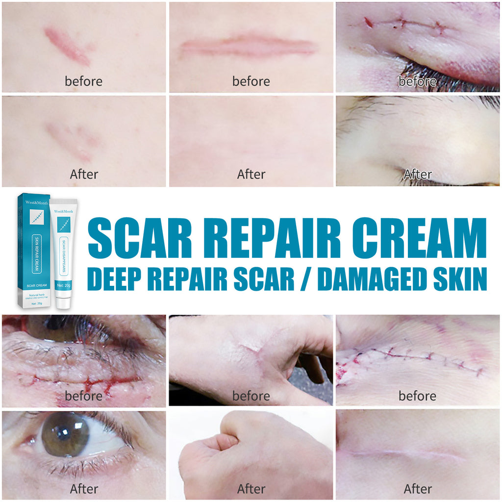 Scar Repair Cream Desalinates Old Scald Burns