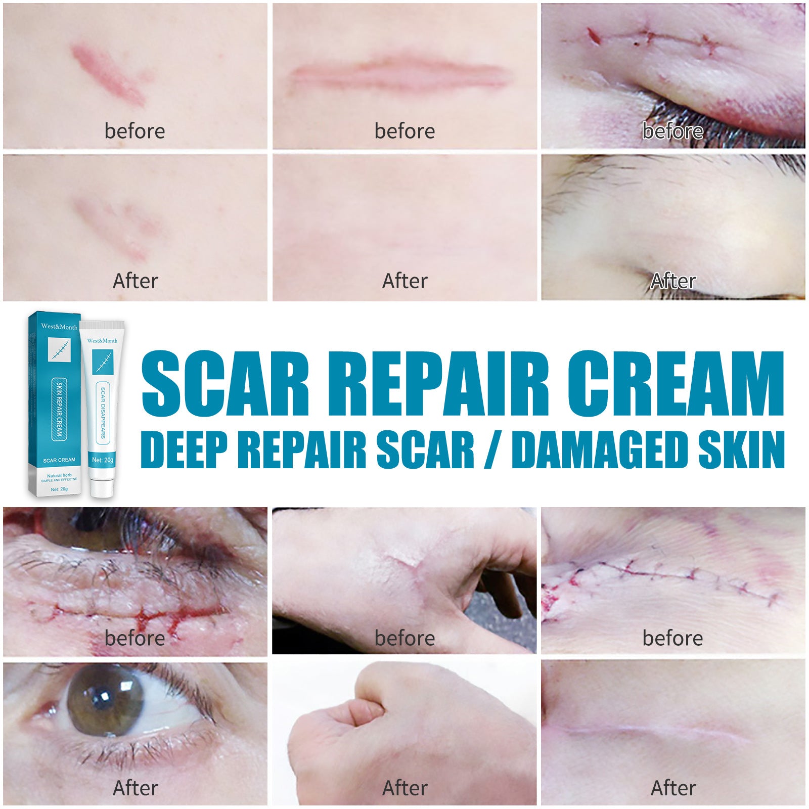 Scar Repair Cream Desalinates Old Scald Burns