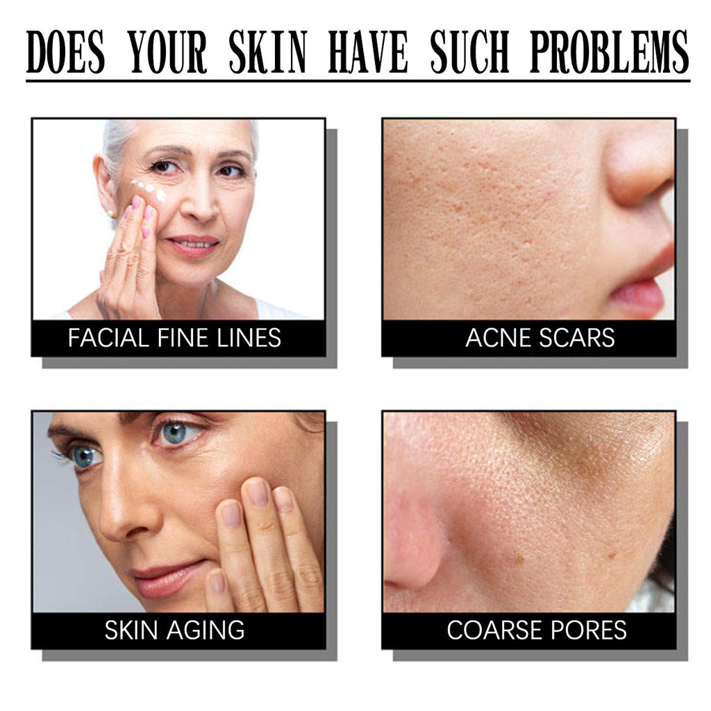 Exfoliating Smallpox Diluting Salicylate Nourishing Moisturizing Cream