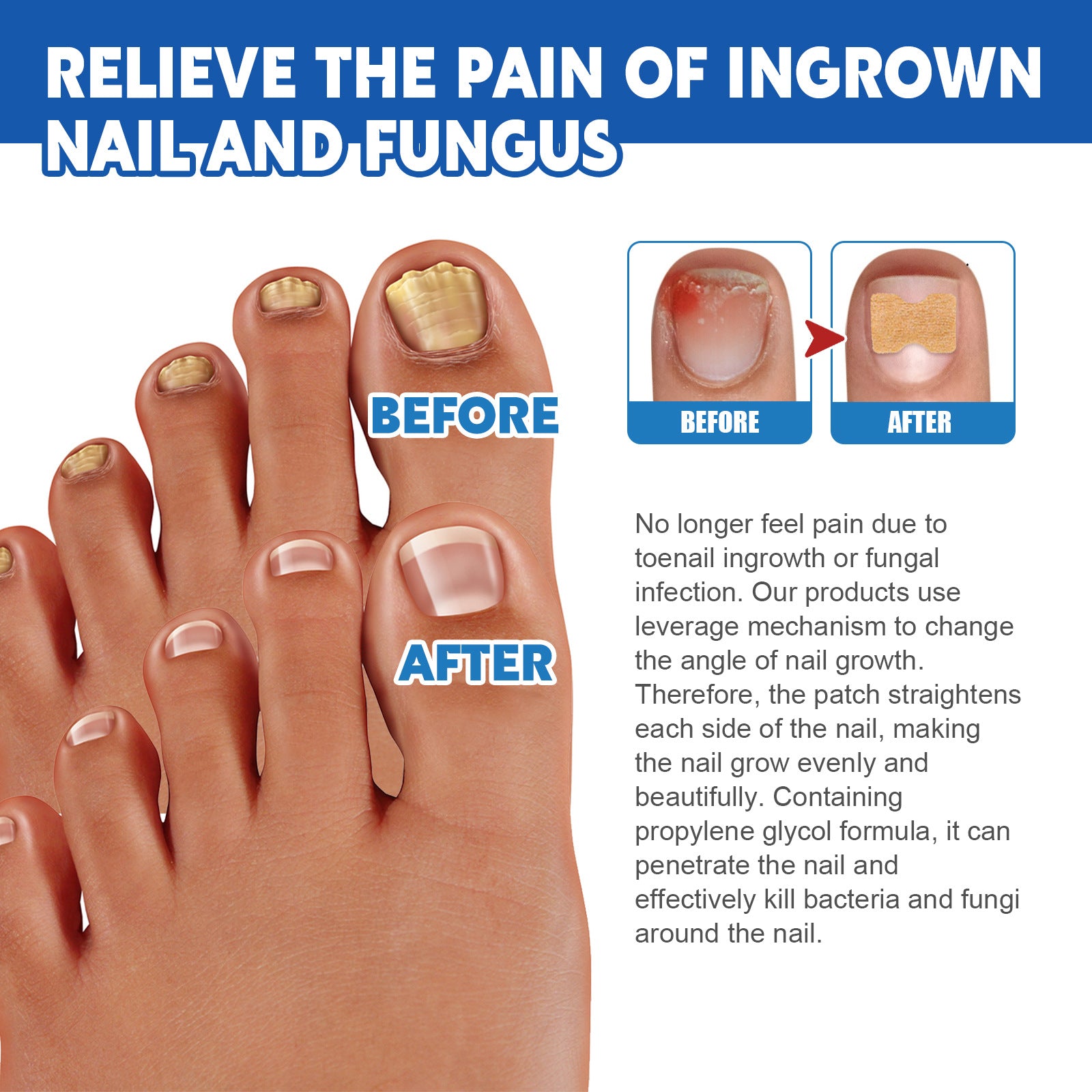 Jaysuing Nail Groove Nursing Adhesive Bandage Repair Thickened Gray Nail Soft Nail Correction