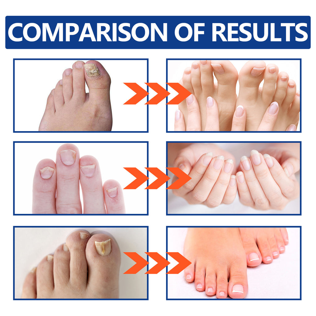 Eohoe Repair Soft Nail Care Phototherapy Device