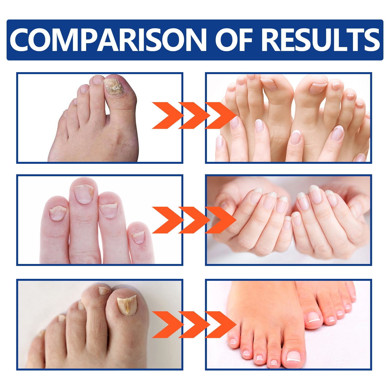 Eohoe Repair Soft Nail Care Phototherapy Device