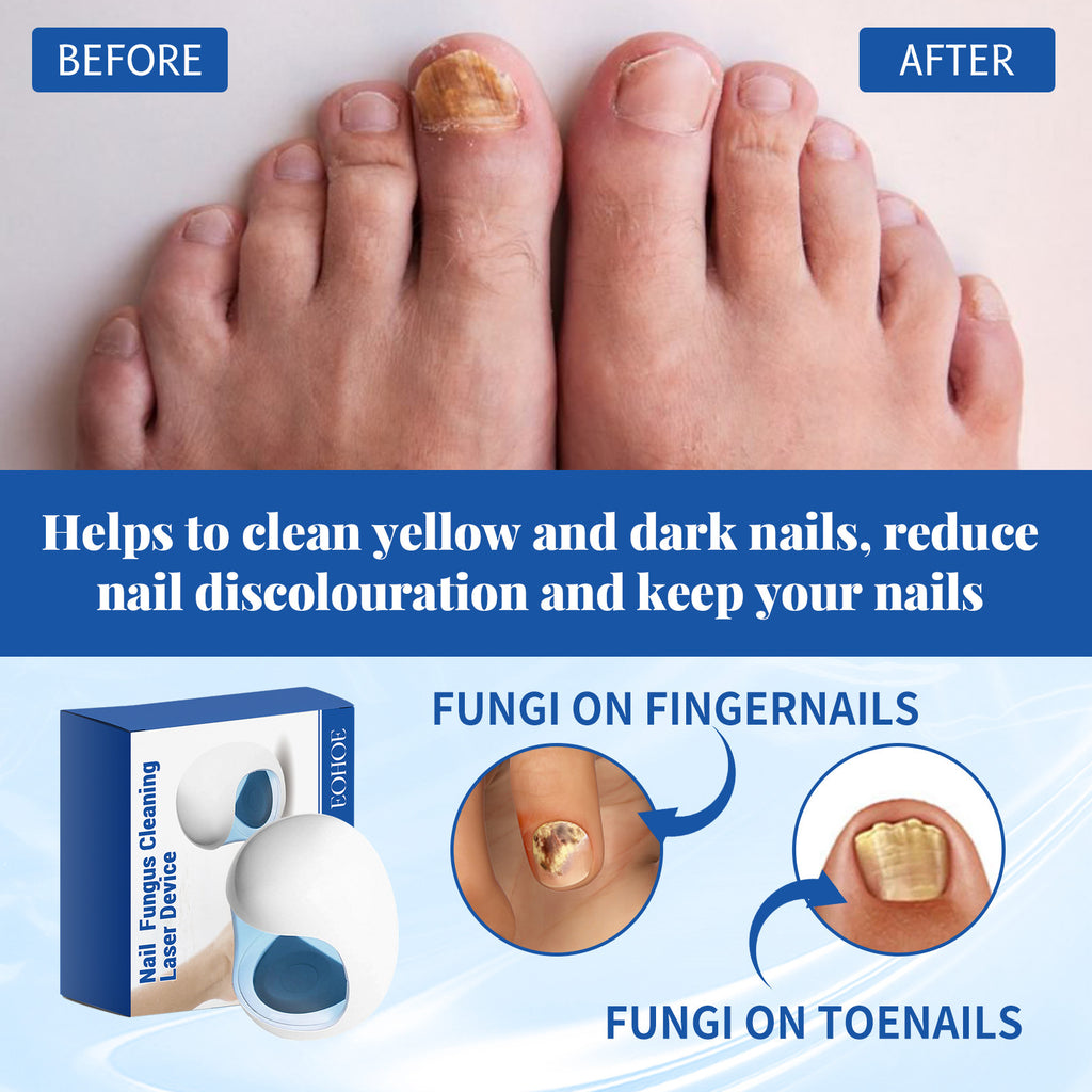 Eohoe Nail Care Phototherapy Device Gentle Cleaning