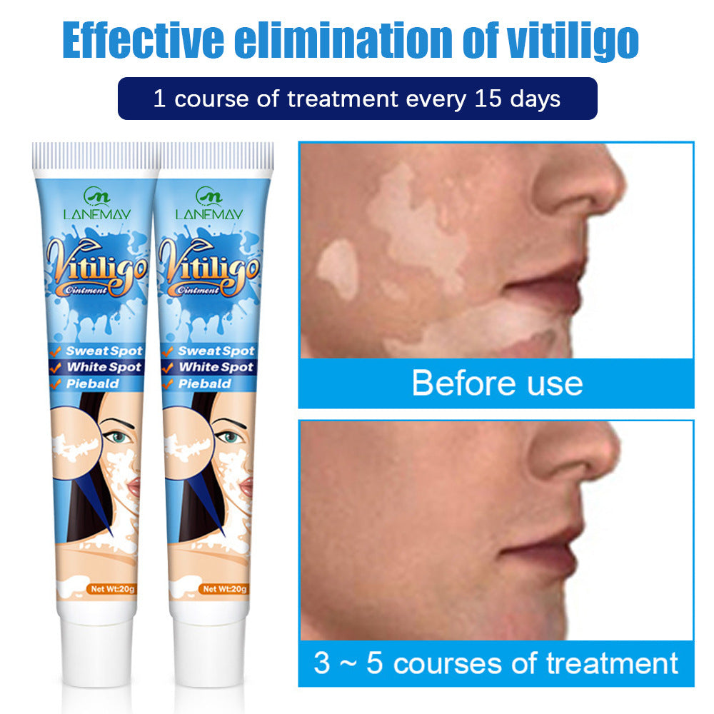 Vitiligo Sweat Spotted Skin Care Repair Cream