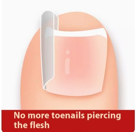 Special Nail Embedding Device For Correcting Paronychia