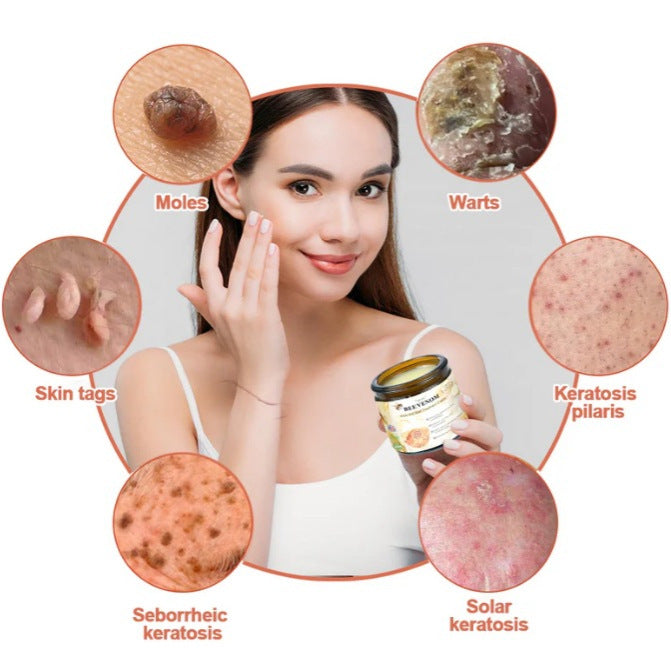 Mole And Wart Body Cream Fade Skin Cleaning