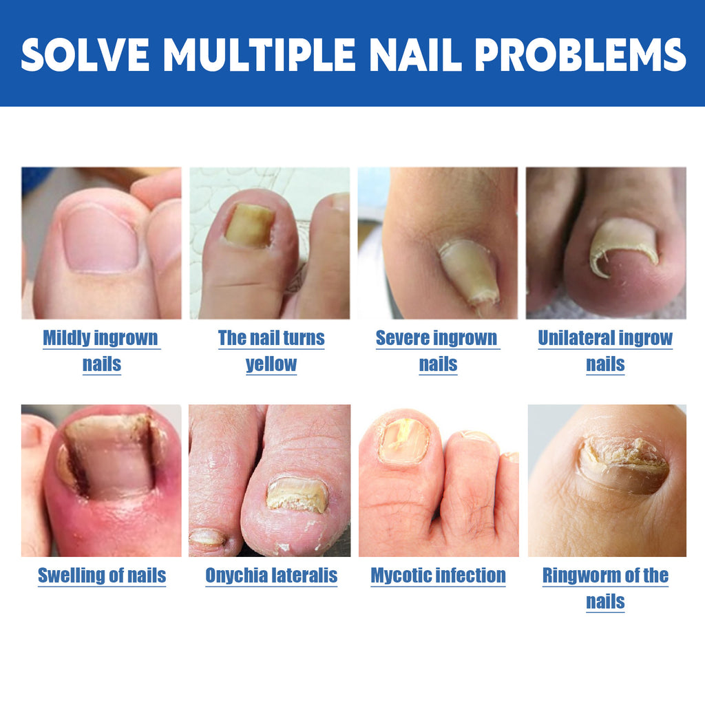 Jaysuing Nail Groove Nursing Adhesive Bandage Repair Thickened Gray Nail Soft Nail Correction