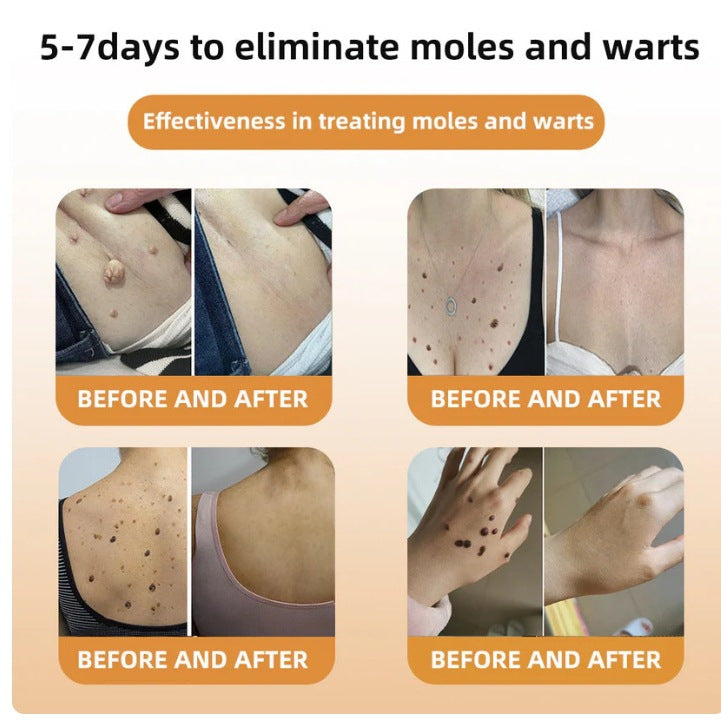 Mole And Wart Body Cream Fade Skin Cleaning