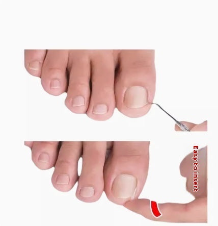 Special Nail Embedding Device For Correcting Paronychia