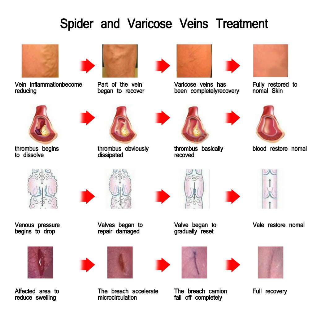 Nursing vein cream
