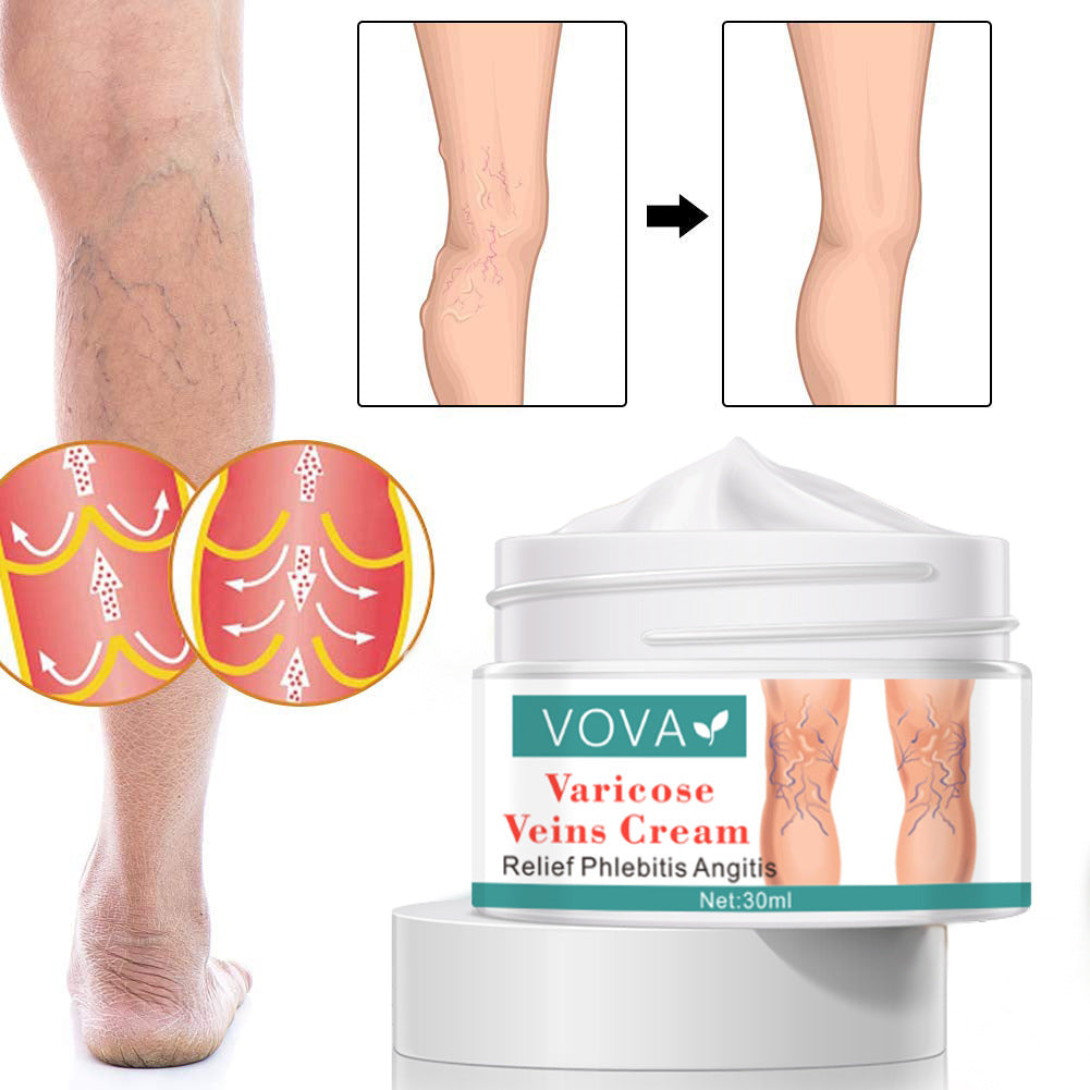 Spider Leg Varicose Vein Repair Cream