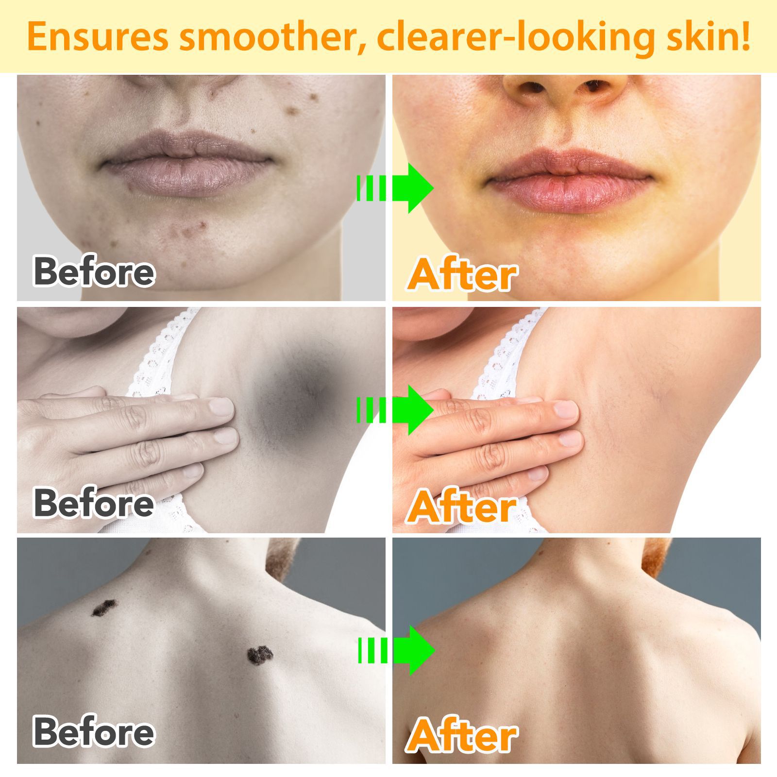 Exfoliating Smooth Skin Moles Wart Cream