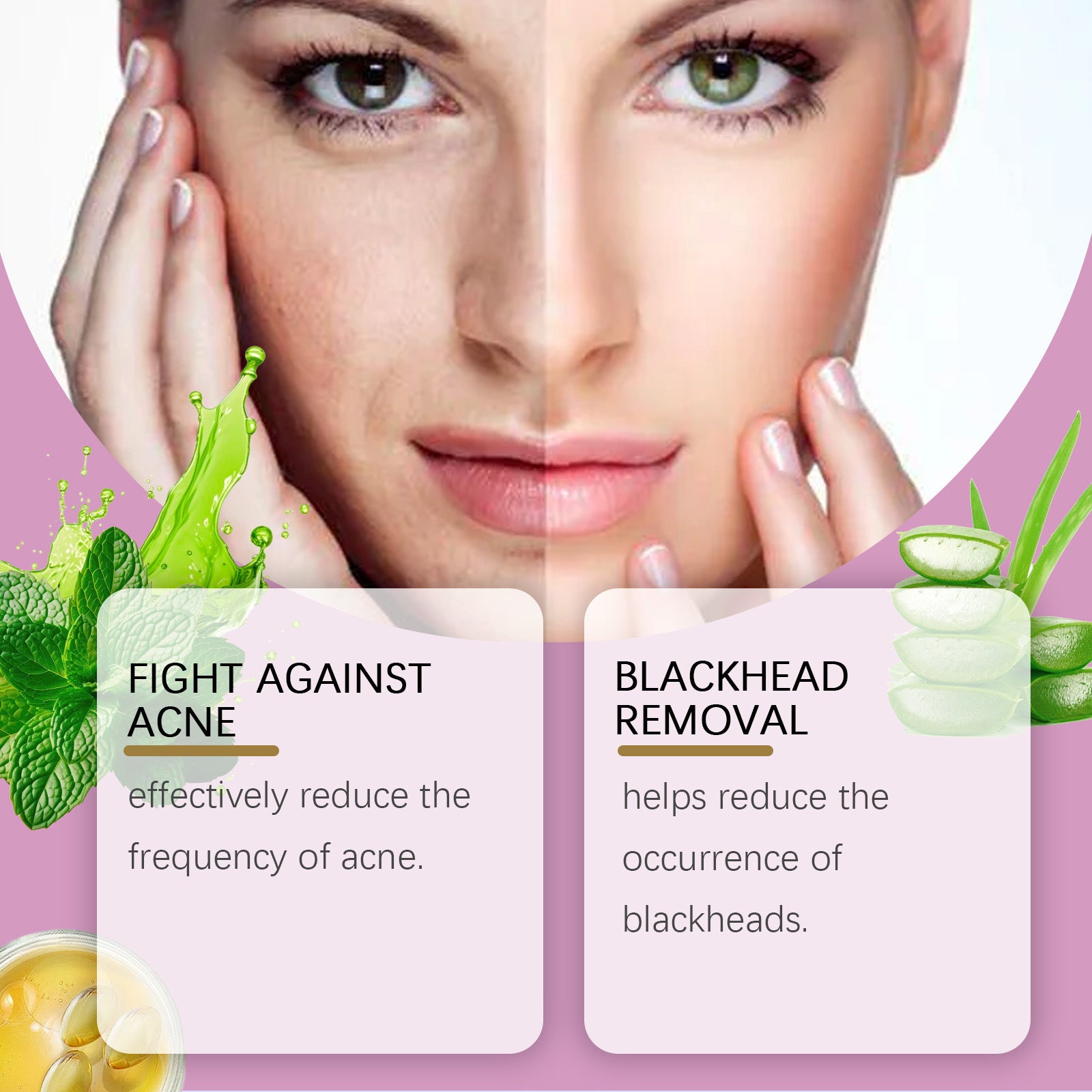 Mild Improvement Of Salicylate Acne Cream