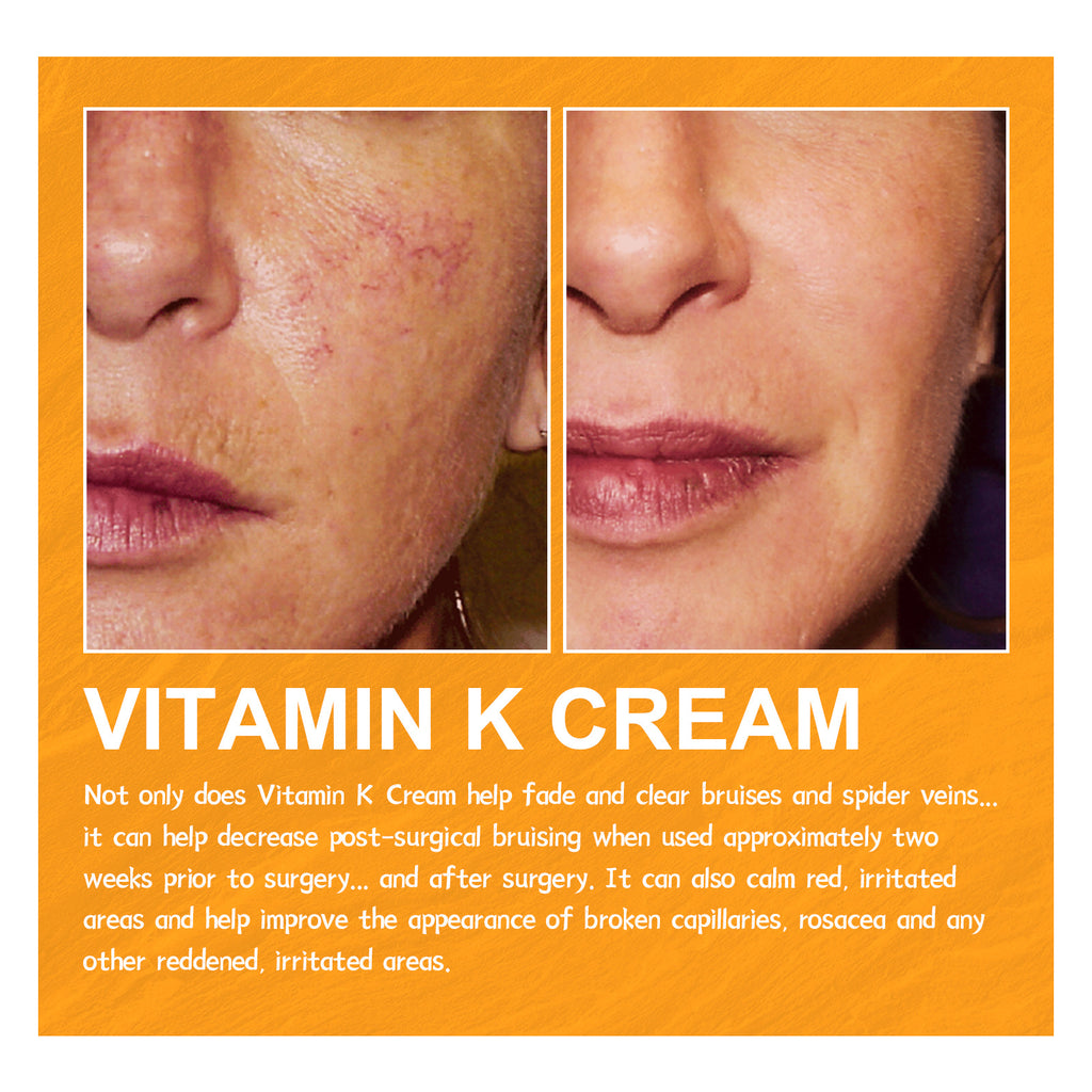 Bulge And Swelling Of Legs Repair Cream
