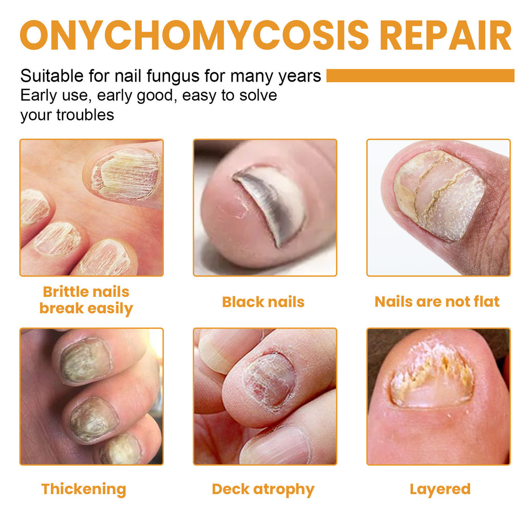 Ximonth Nail Repair Patch Repair Ingrown Nail