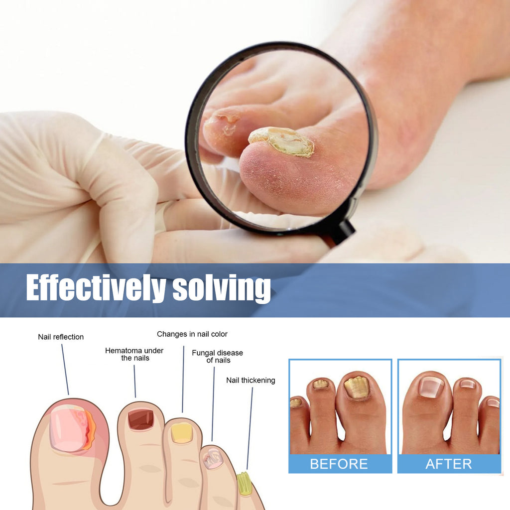 Ximonth Nail Nursing Adhesive Bandage Repair