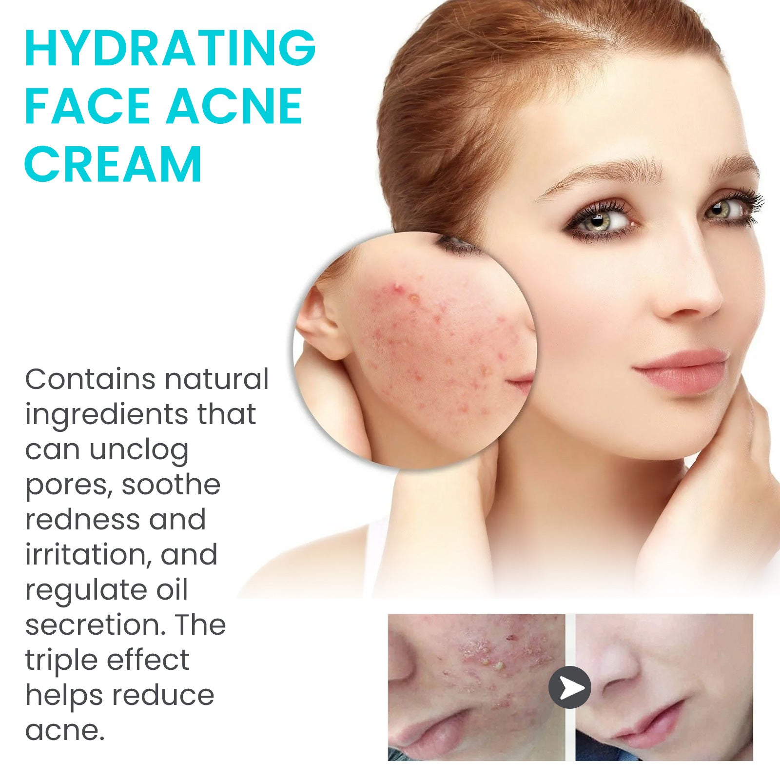 Desalting Pimple Moisturizing Delicate Skin Lightening Cream