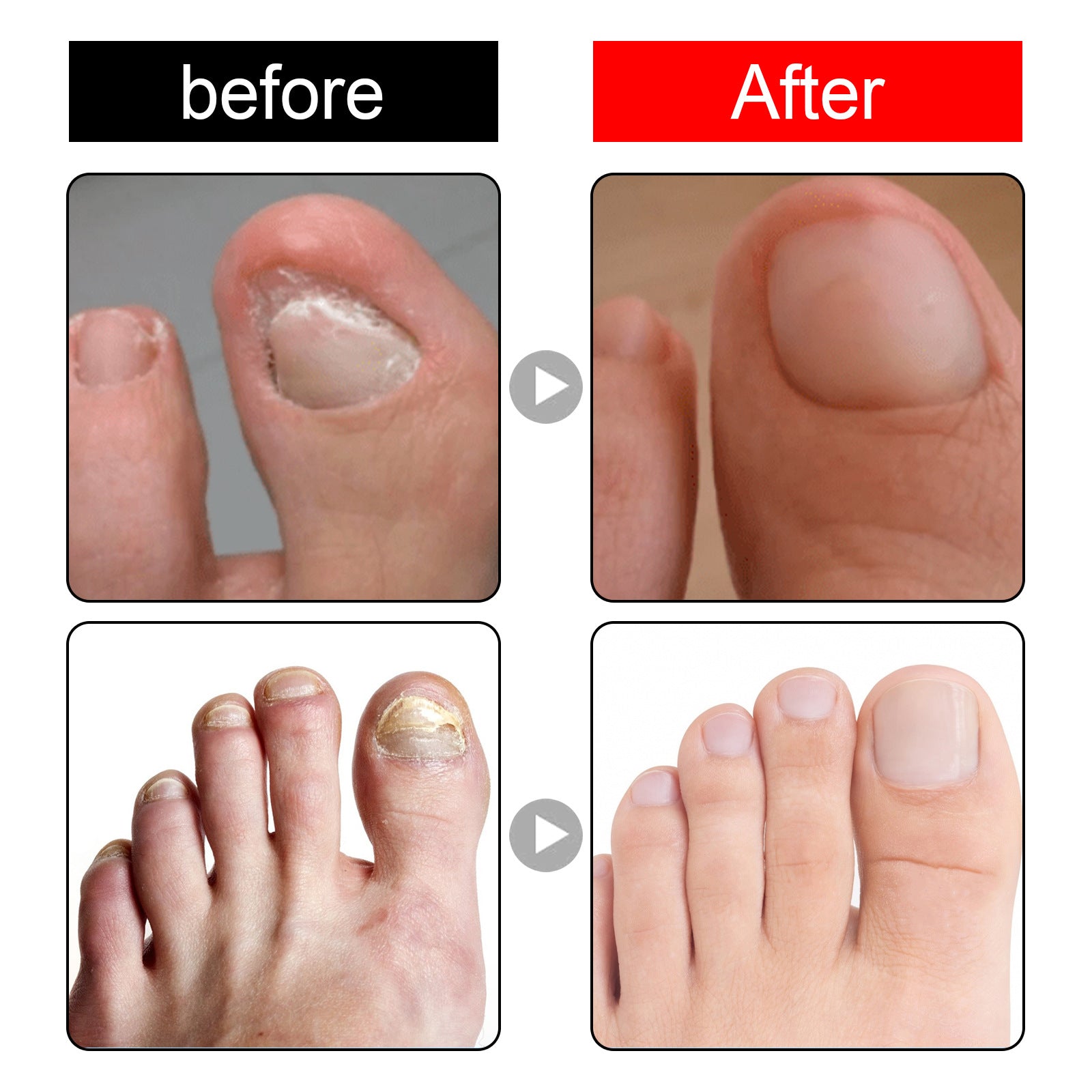 South Moon Endogenous Nail Repair Nail Repair Cleaning Nail Removal Nail Care Essential Oil