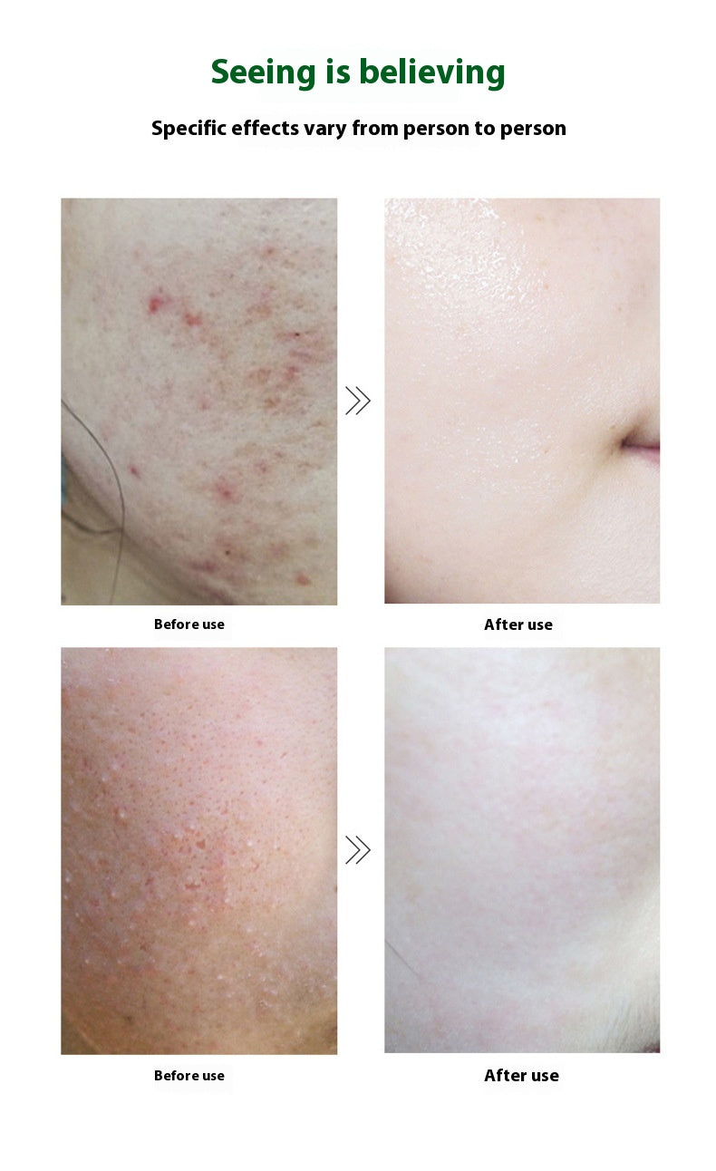 3ml Skin Clearing And Acne Removing Beauty Salon Freeze-dried Power