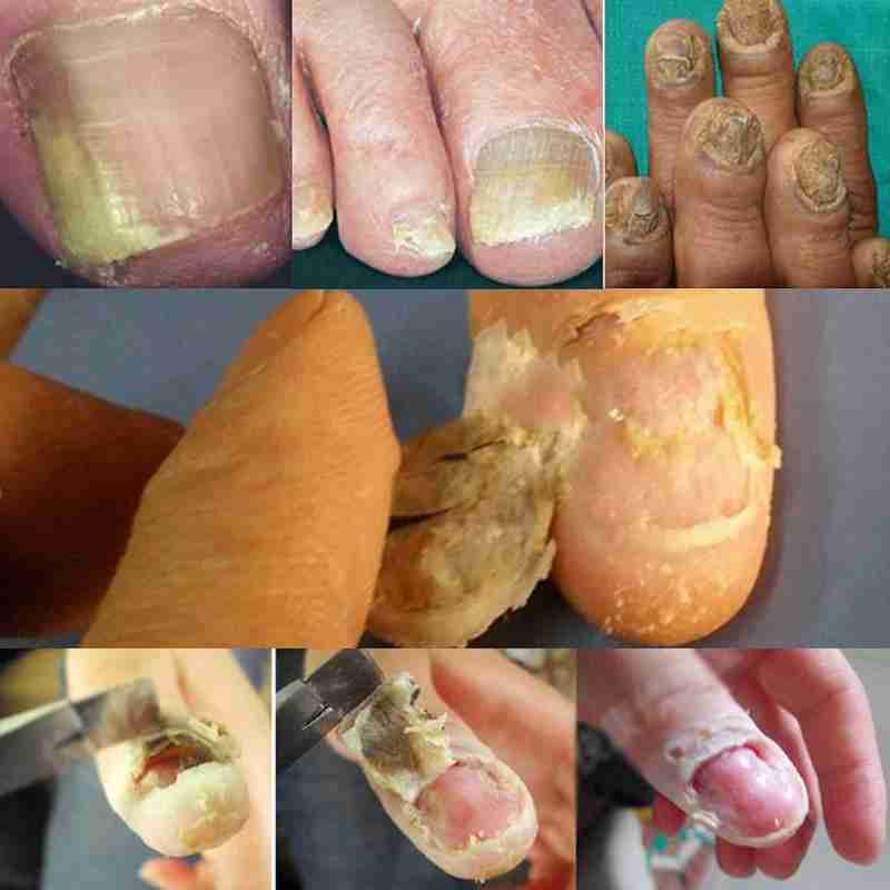Fungal Nail Remove Nail Removal Cream Packet