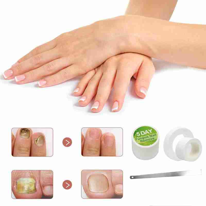 Fungal Nail Remove Nail Removal Cream Packet