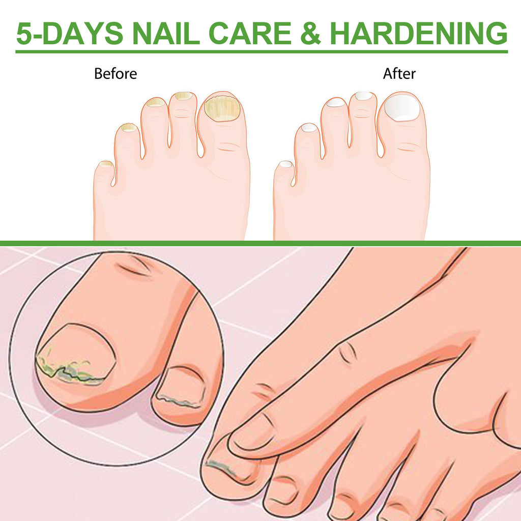 South Moon Nail Repair Roller Gray Thickening Nail Care Solution