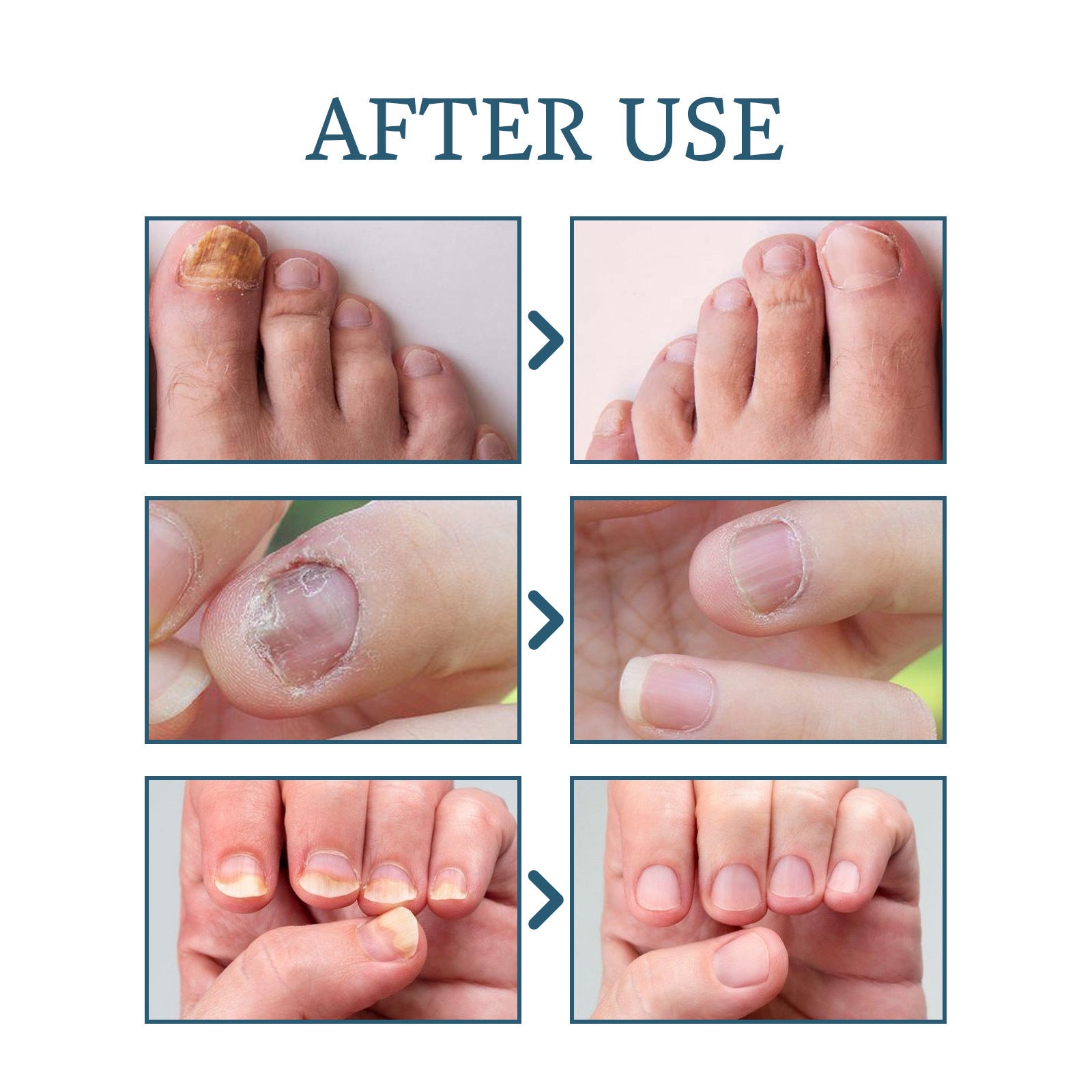 Ximonth Nail Repair Embedded Thickening Bright Nail