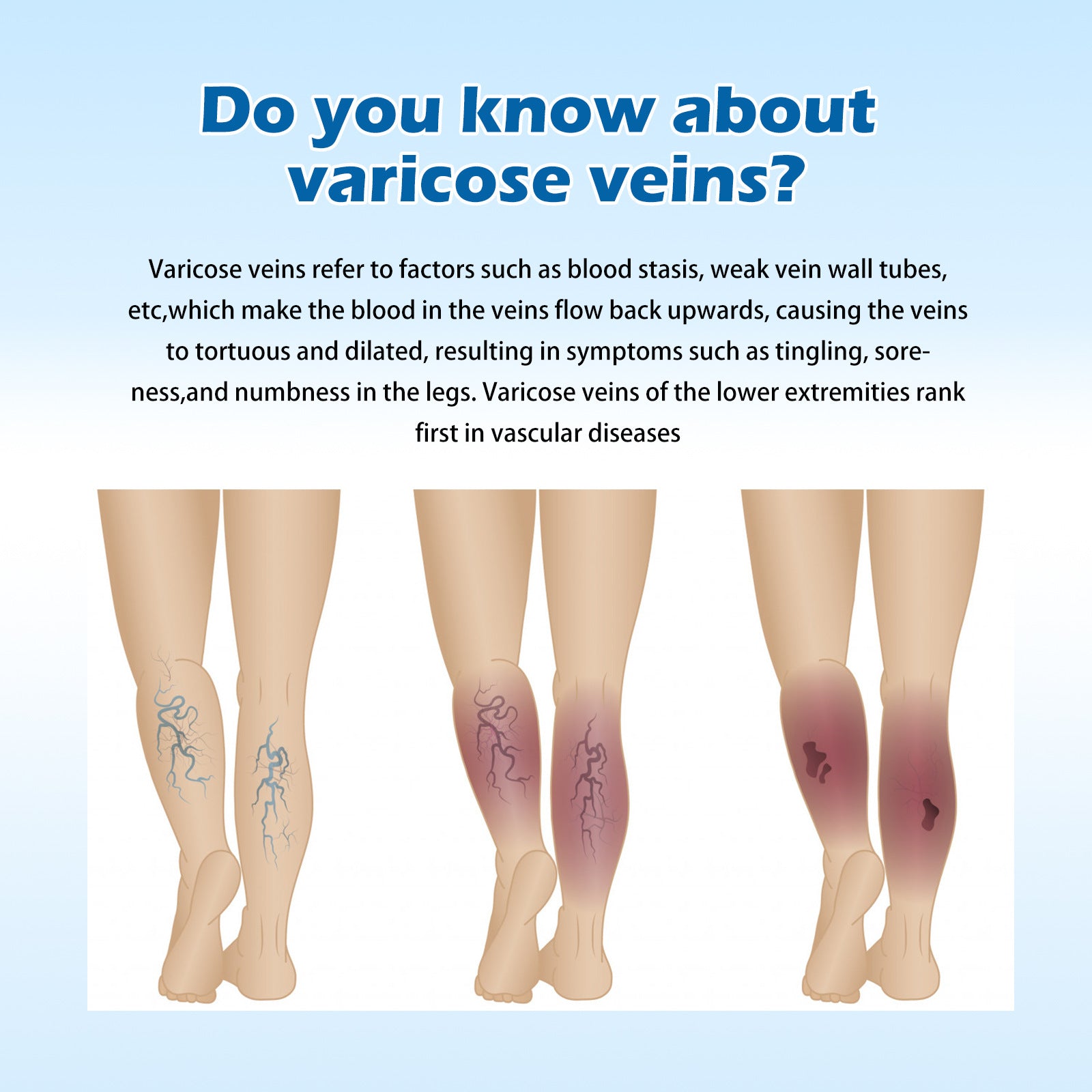 OUHOE Vein Slimming Cream Vein Repair Body Care