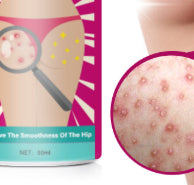 Hip And Leg Acne Cream Moisturizing
