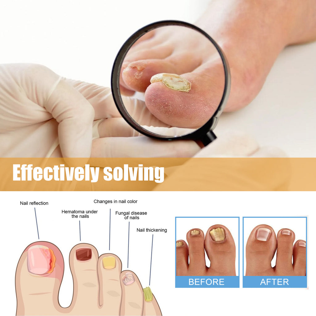 Ximonth Nail Repair Patch Repair Ingrown Nail