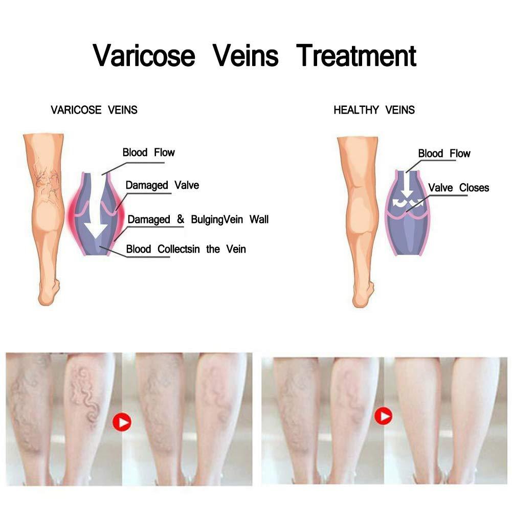 Spider Leg Varicose Vein Repair Cream