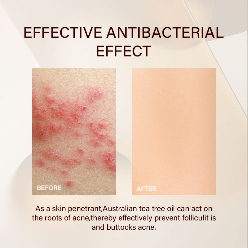 Fade Pox Pits Acne Marks Hip Buttock Cream