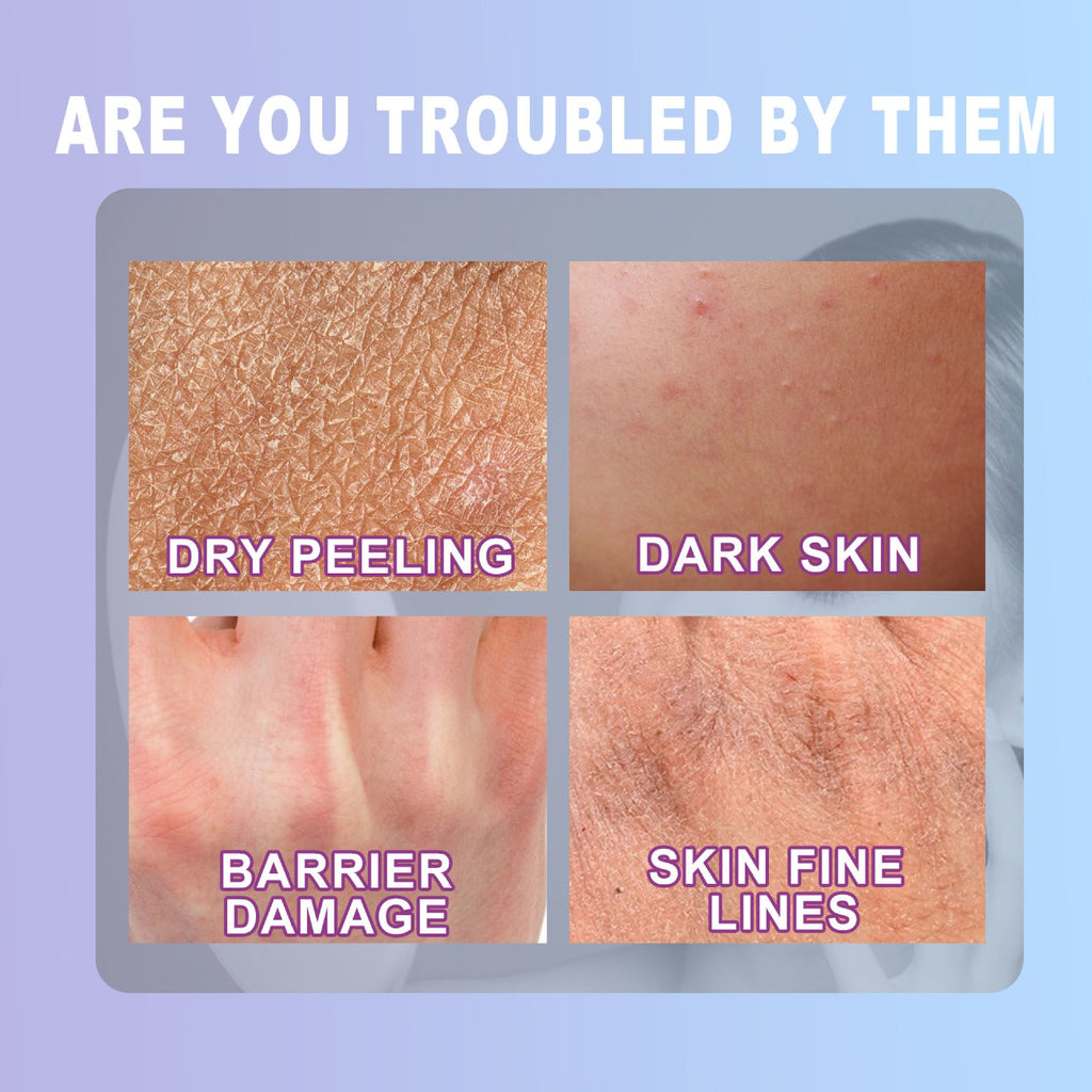 Cracked Hands And Feet Urea Cream Hydrating