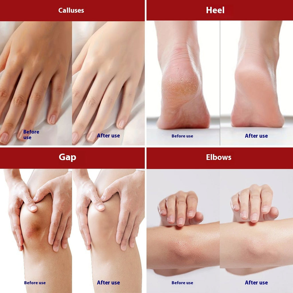 422 Salicylate Urea Cream Anti-chapping Moisturizing Cream