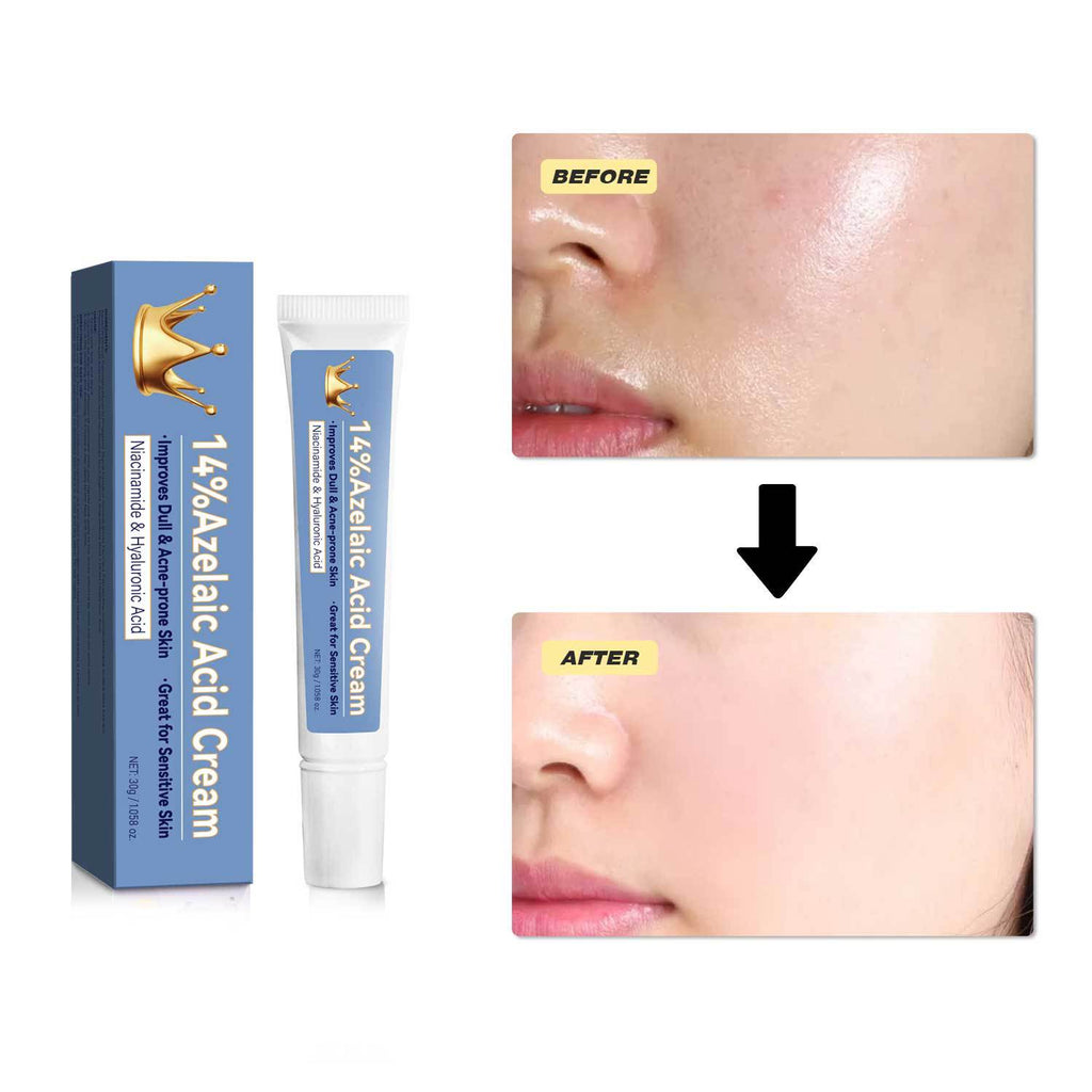 Azelaic Acid Cream 30g Blue