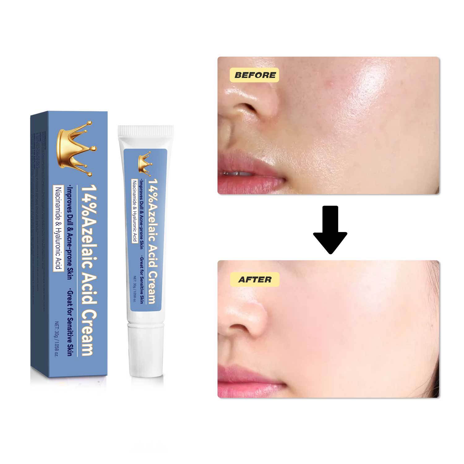 Azelaic Acid Cream 30g Blue